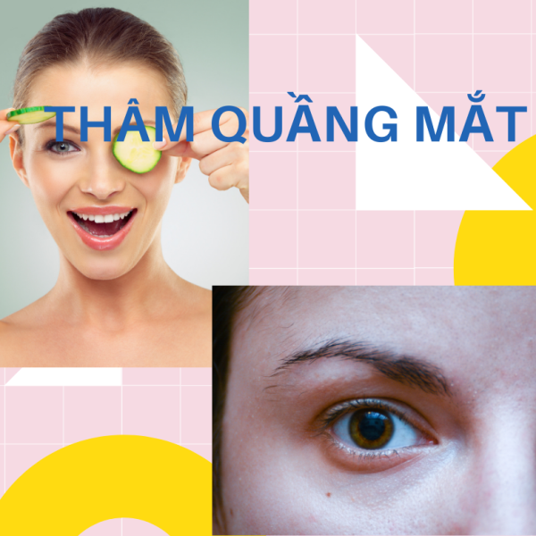 4 cách trị thâm quầng mắt hiệu quả